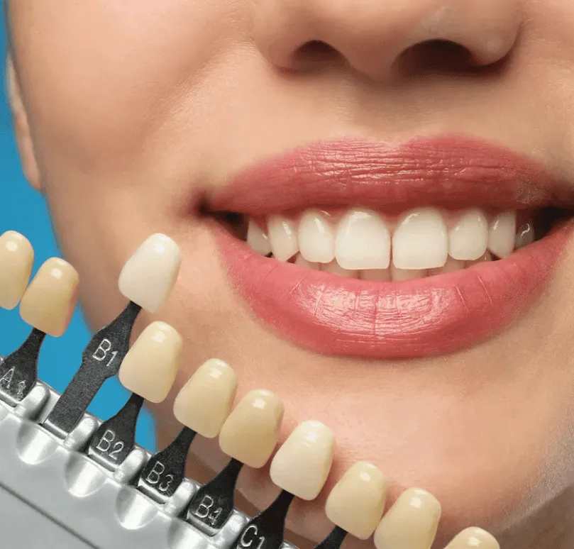 Minimal Prep Veneers